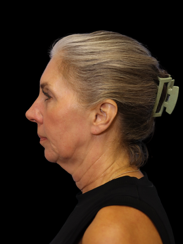 Deep Plane Facelift Gallery Before & After