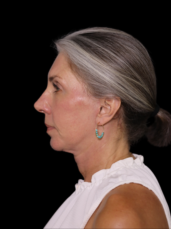 Deep Plane Facelift Gallery Before & After