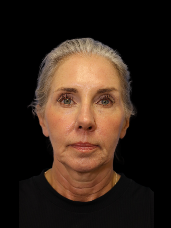 Deep Plane Facelift Gallery Before & After