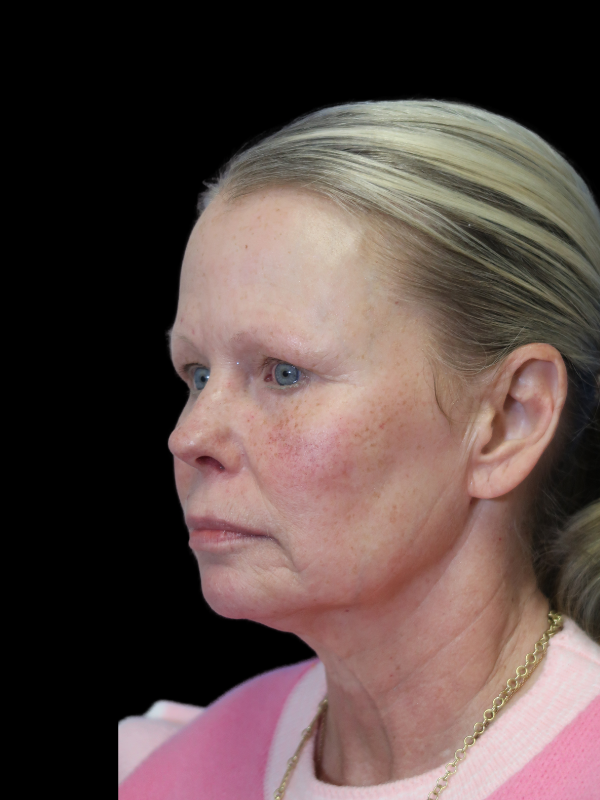 Deep Plane Facelift Gallery Before & After