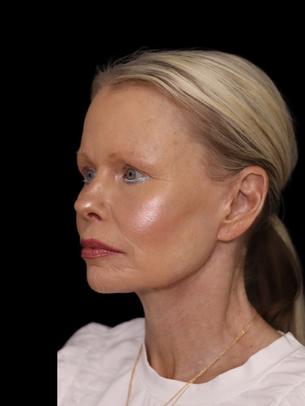 Deep Plane Facelift Gallery Before & After