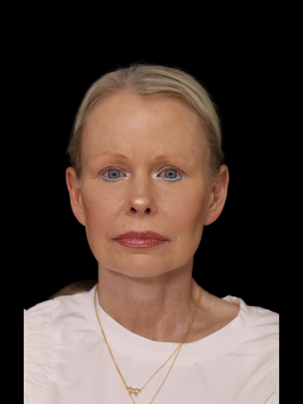 Deep Plane Facelift Gallery Before & After