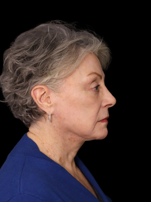 Deep Plane Facelift Gallery Before & After