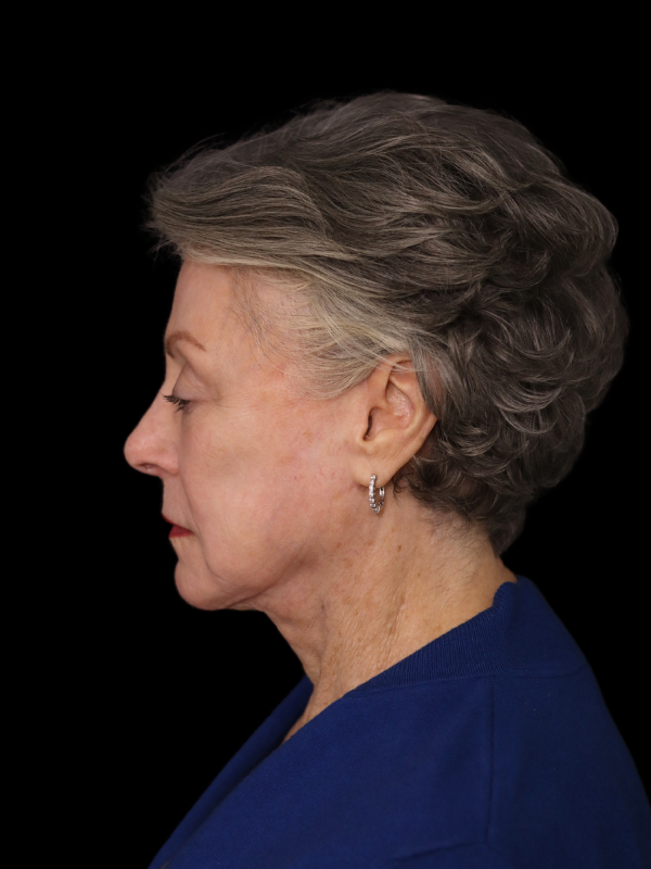 Deep Plane Facelift Gallery Before & After