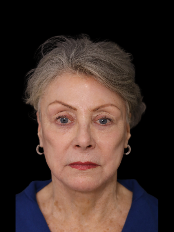 Deep Plane Facelift Gallery Before & After
