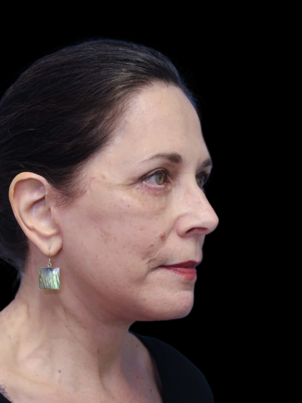 Deep Plane Facelift Gallery Before & After