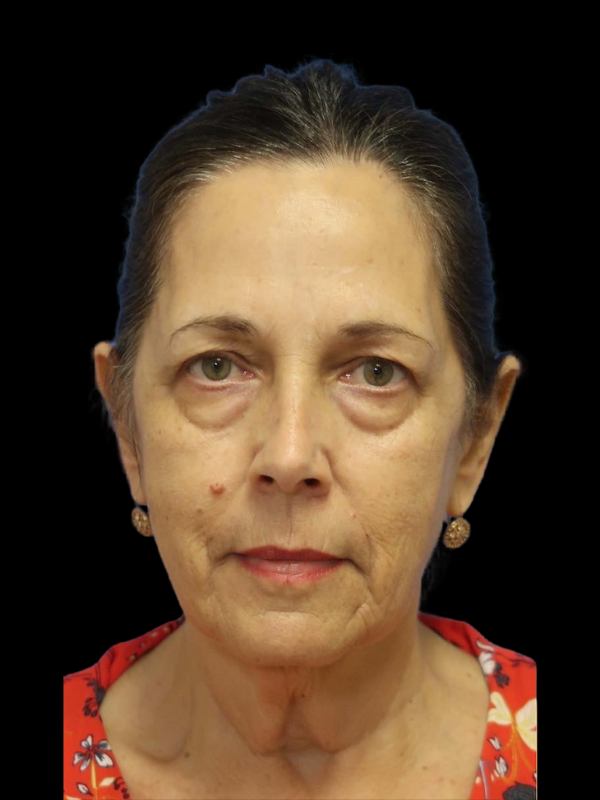 Deep Plane Facelift Gallery Before & After