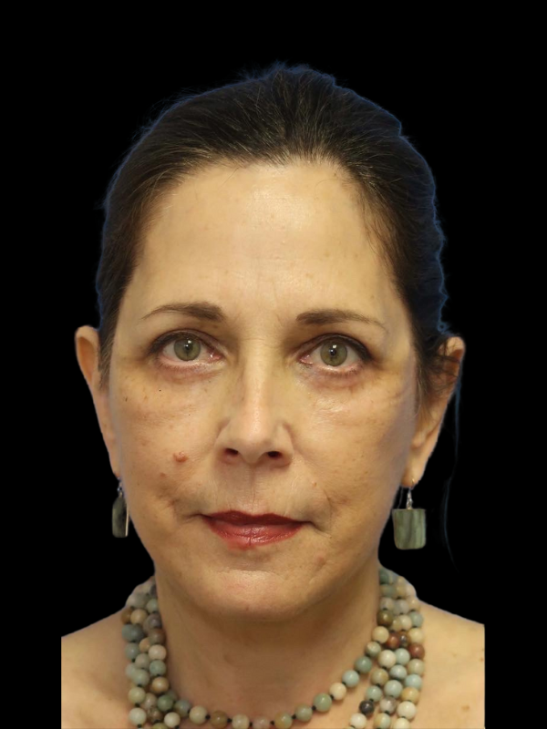 Deep Plane Facelift Gallery Before & After