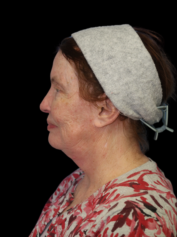 Deep Plane Facelift Gallery Before & After