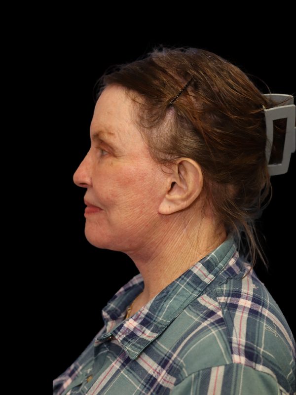 Deep Plane Facelift Gallery Before & After