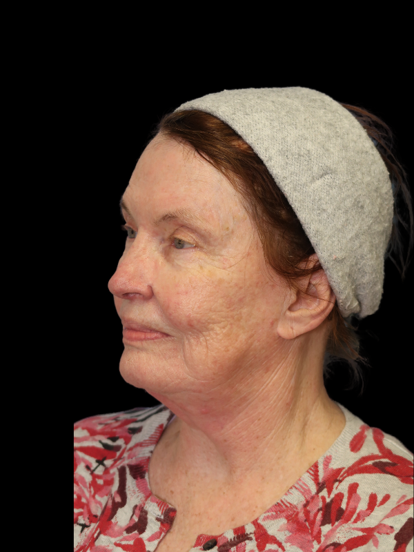 Deep Plane Facelift Gallery Before & After