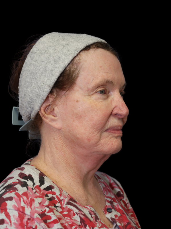 Deep Plane Facelift Gallery Before & After