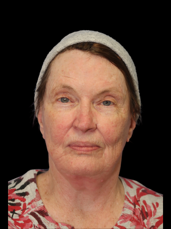 Deep Plane Facelift Gallery Before & After