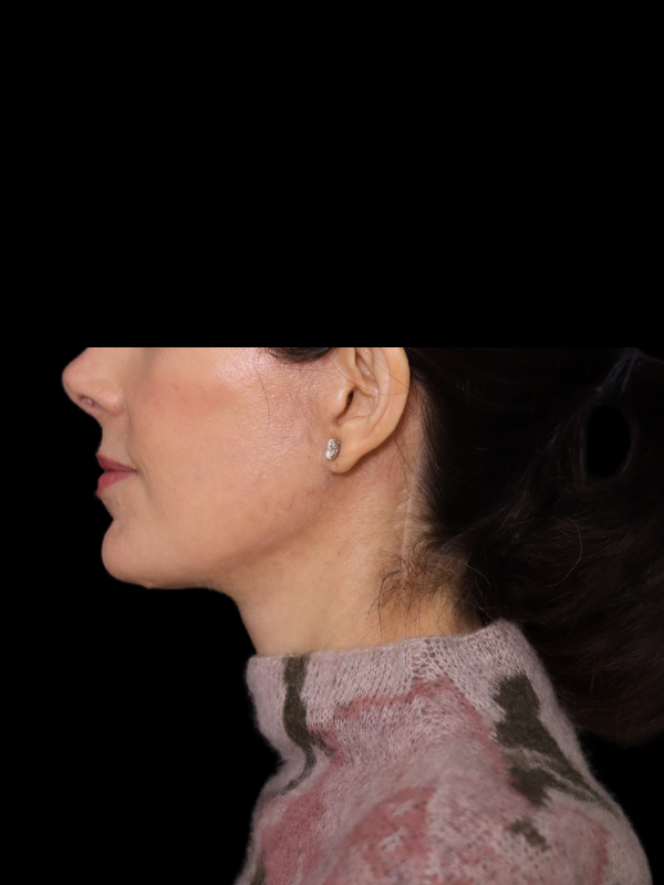 Deep Plane Facelift Gallery Before & After