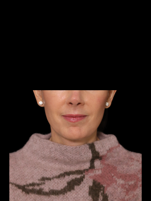 Deep Plane Facelift Gallery Before & After