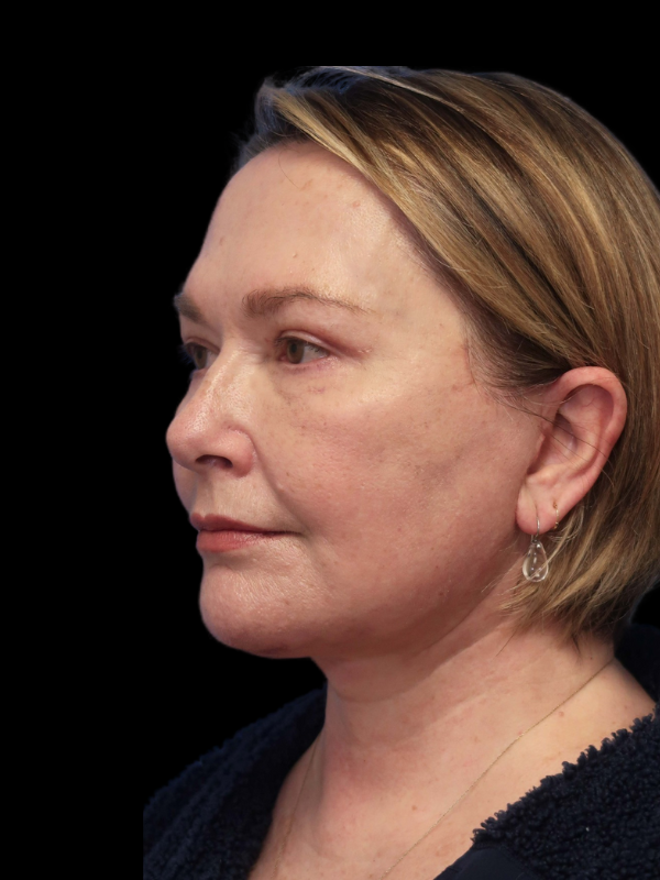 Deep Plane Facelift Gallery Before & After