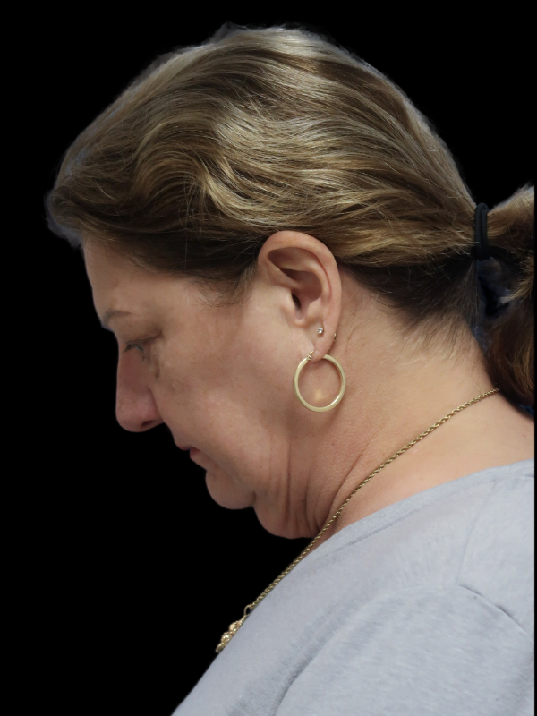 Deep Plane Facelift Gallery Before & After