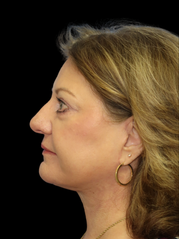 Deep Plane Facelift Gallery Before & After