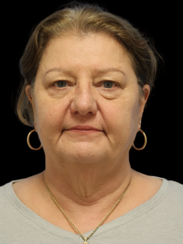 Deep Plane Facelift Gallery Before & After