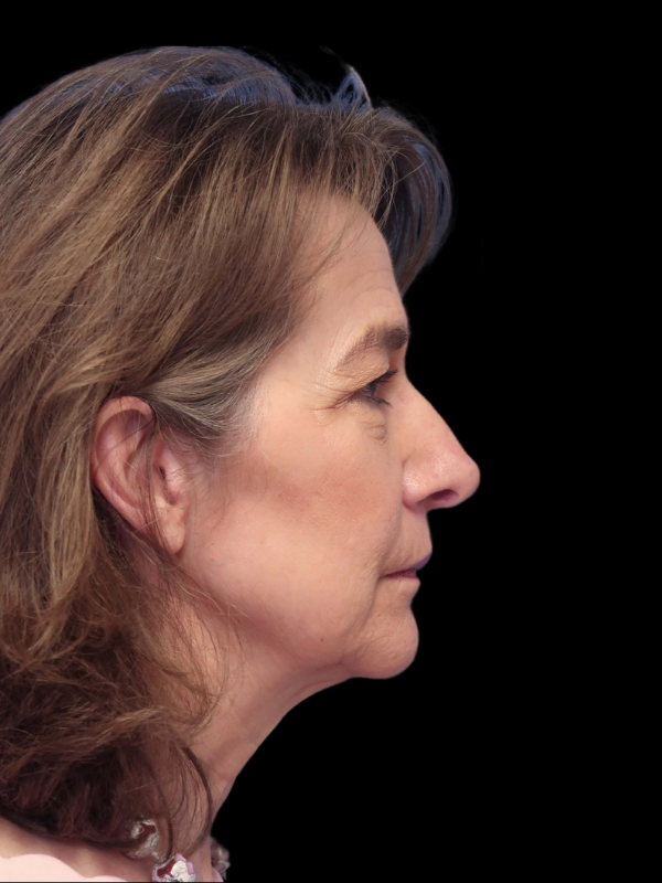 Deep Plane Facelift Gallery Before & After