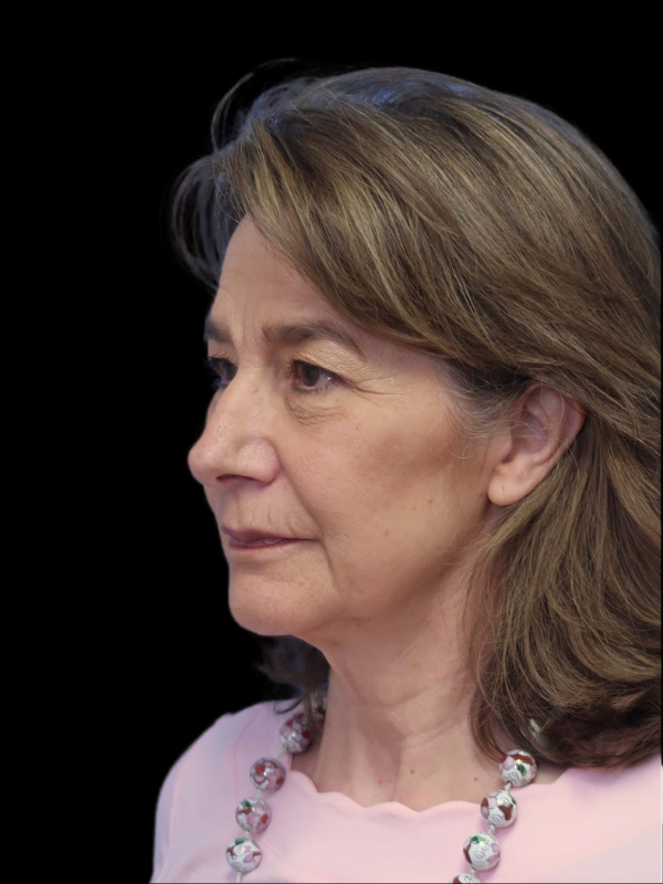 Deep Plane Facelift Gallery Before & After