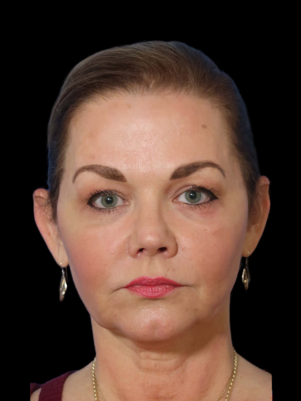 Deep Plane Facelift Gallery Before & After