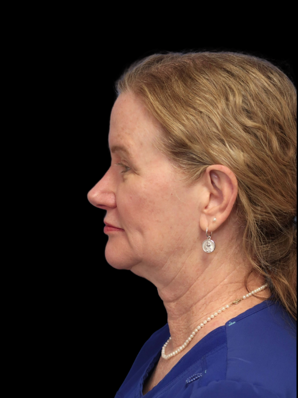 Deep Plane Facelift Gallery Before & After