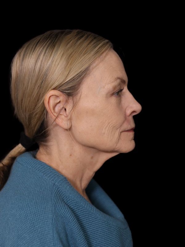 Deep Plane Facelift Gallery Before & After