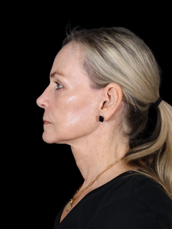 Deep Plane Facelift Gallery Before & After