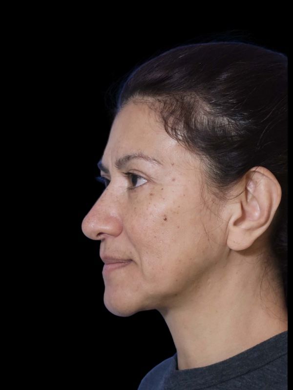 Deep Plane Facelift Gallery Before & After