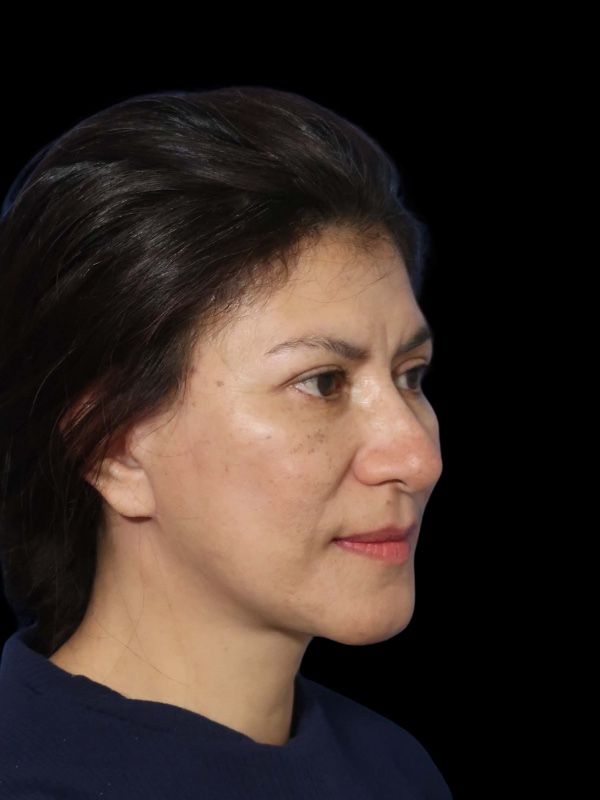 Deep Plane Facelift Gallery Before & After