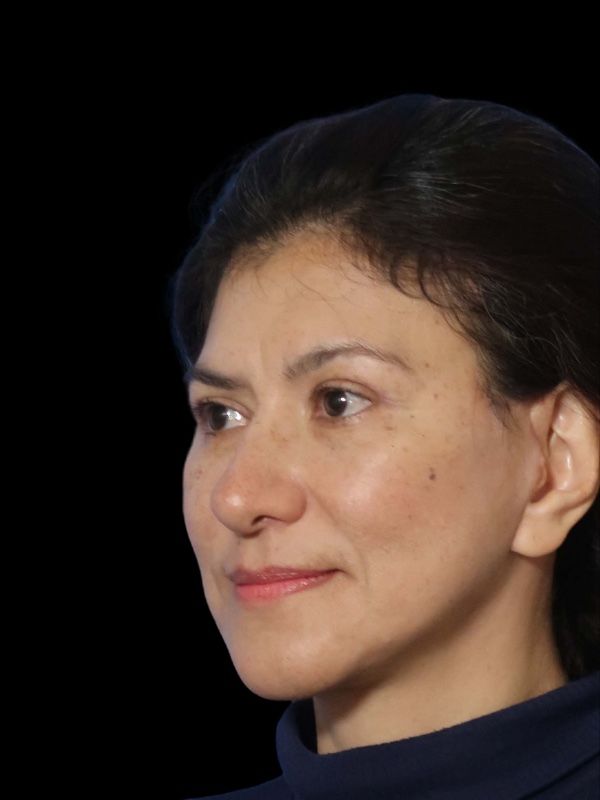 Deep Plane Facelift Gallery Before & After