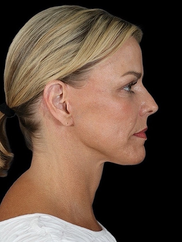 Deep Plane Facelift Gallery Before & After