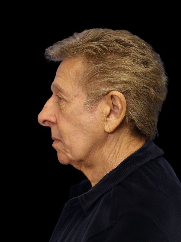 Deep Plane Facelift Gallery Before & After