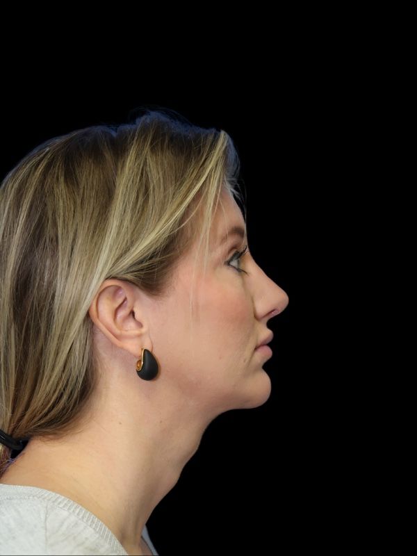 Deep Plane Facelift Gallery Before & After