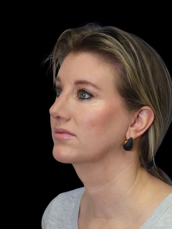 Deep Plane Facelift Gallery Before & After