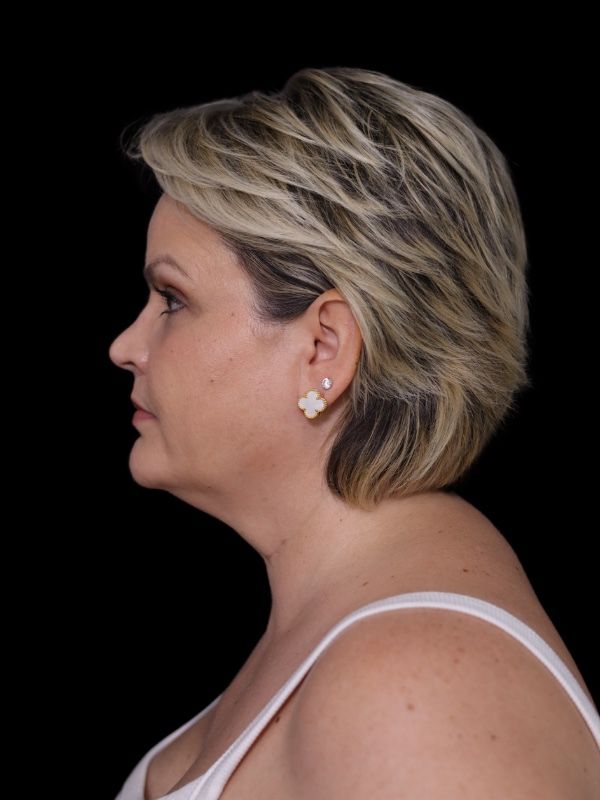 Deep Plane Facelift Gallery Before & After