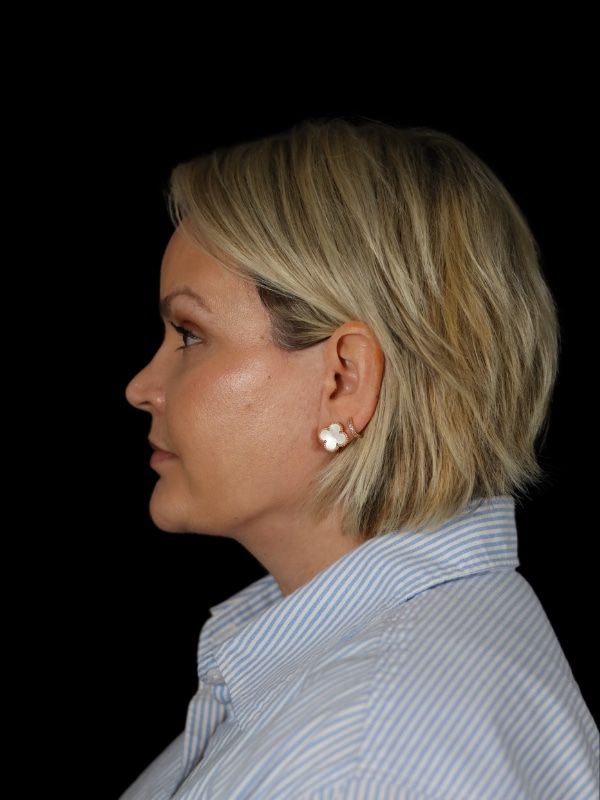 Deep Plane Facelift Gallery Before & After