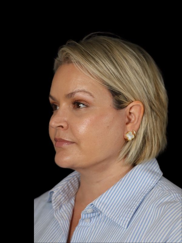 Deep Plane Facelift Gallery Before & After