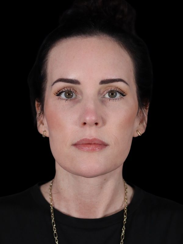 Deep Plane Facelift Gallery Before & After