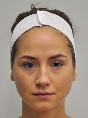 Filler Before & After