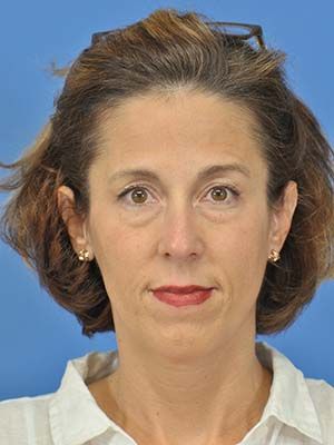 Filler Before & After