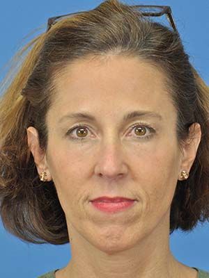 Filler Before & After