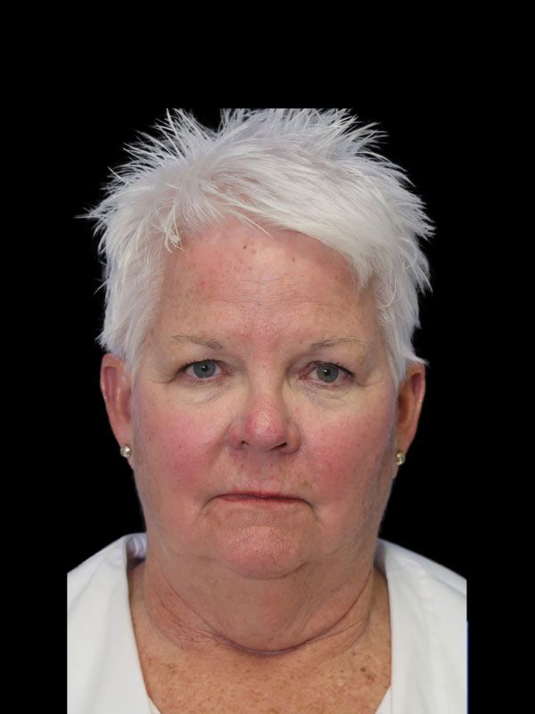 Endoscopic Browlift Gallery Before & After