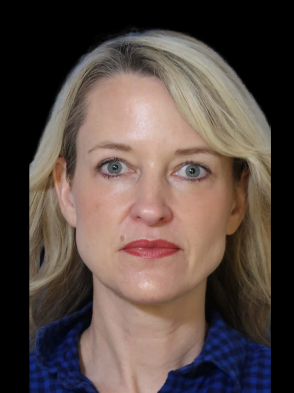 Endoscopic Browlift Gallery Before & After