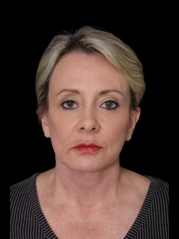 Endoscopic Browlift Gallery Before & After