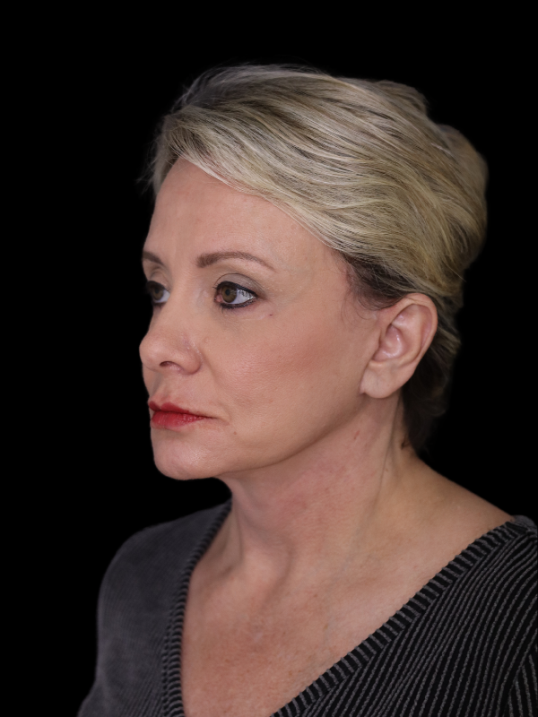 Endoscopic Browlift Gallery Before & After