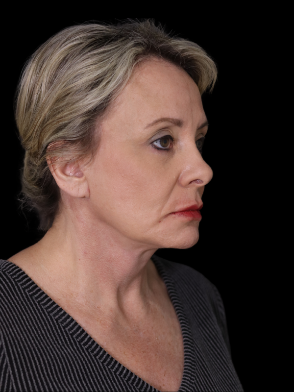 Endoscopic Browlift Gallery Before & After