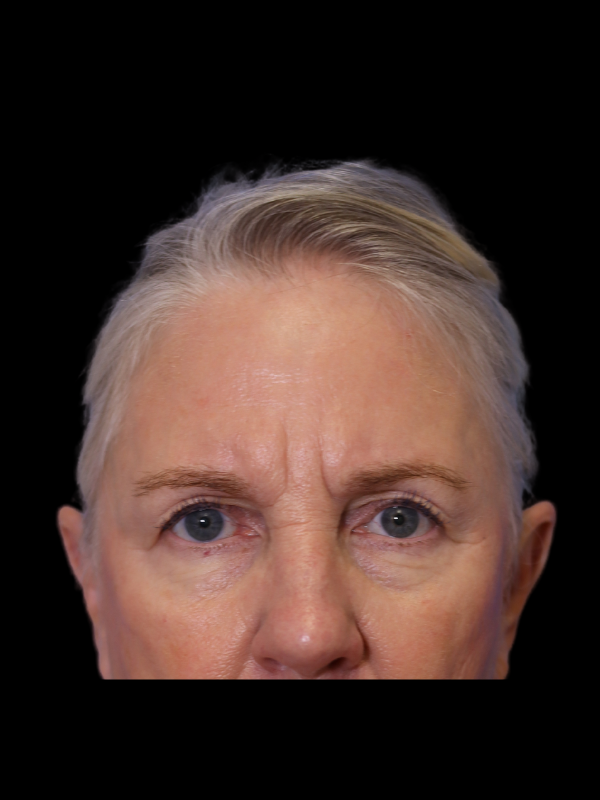 Endoscopic Browlift Gallery Before & After