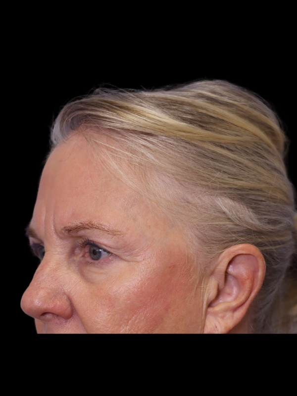 Endoscopic Browlift Gallery Before & After